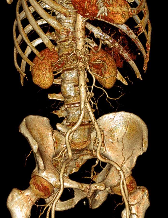 Мультиспиральная компьютерно-томографическая ангиография аорты, почечных артерий, трехмерная реконструкция