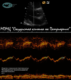 Эхокардиография_5
