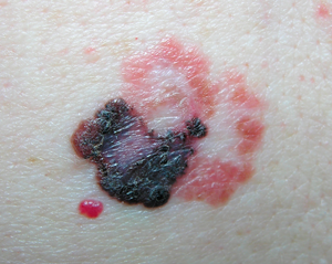 Характерные признаки меланомы кожи могут быть выявлены при эпилюминесцентной дерматоскопии