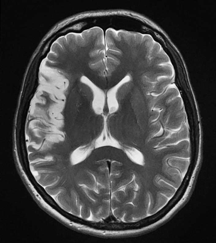МРТ - магнитнорезонансная томограмма - головного мозга