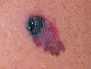Меланома кожи: эпилюминесцентная дерматоскопия