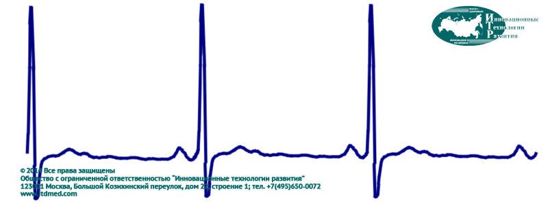 Электрокардиограмма - ЭКГ - запись биоэлектрической активности сердца