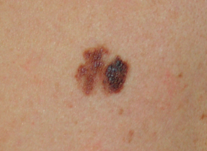 При помощи эпилюминесцентной дерматоскопии могут быть зарегистрированы признаки меланомы кожи